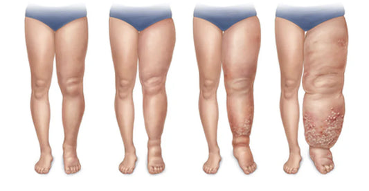 Linfedema